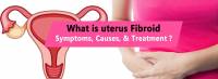 Uterus fibroid